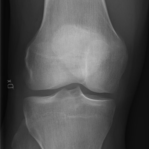 Knee X-ray